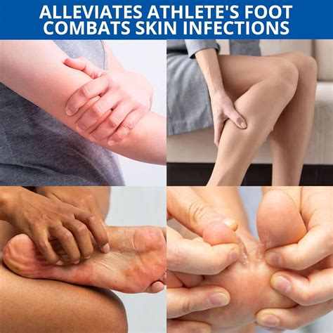 Anti Fungal Skin Cream Antifungal Cream Athletes Foot Treatment