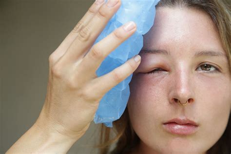 swollen eyelids  treatment myvisionorg