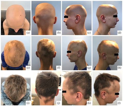 Alopecia Universalis