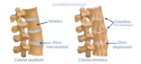 Espondilose Dorsal O Que Significa - Espondilose (artrose na coluna) - causas, sintomas, tratamento, cura