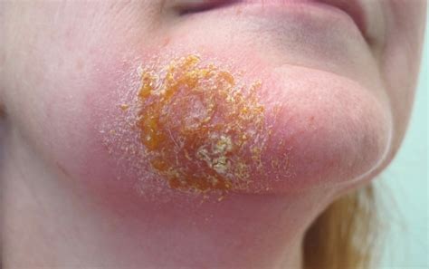 Impetigo - Causes, Symptoms, Treatment, Prevention & Home Treatment