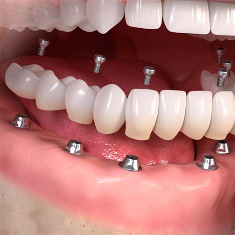 dental implants  sandstone dental practice