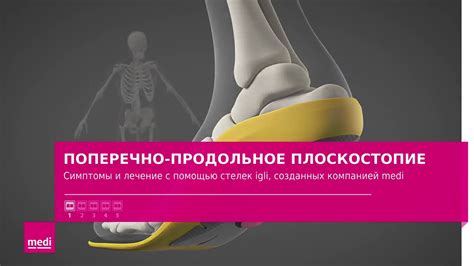 Продольно-поперечное плоскостопие. Симптомы и лечение с помощью стелек ...