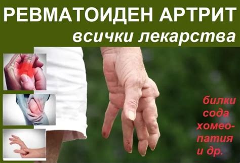 Ревматоиден артрит: първи признаци, диагностика. Лекарства ...