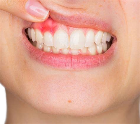 Sore Gums - Woodville Seaton Dentist