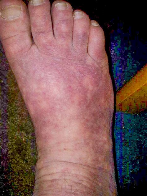 Vasculitis Symptoms