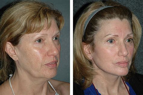 Lower Facelift | Best Lower Facelift Results in New York