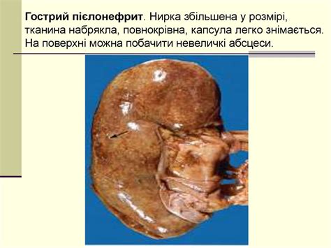 Хвороби нирок - презентация онлайн