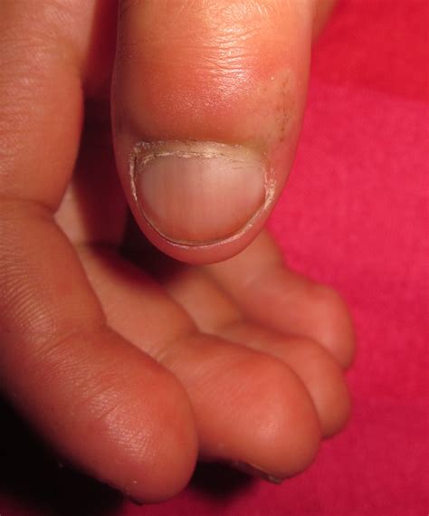 paronychia dermalive