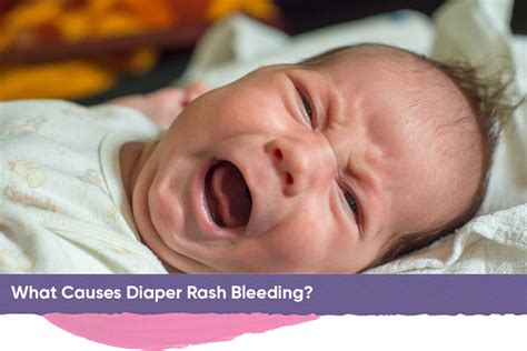 Newborn Diaper Rash Bleeding Prevention & Easy Treatments | MADE OF