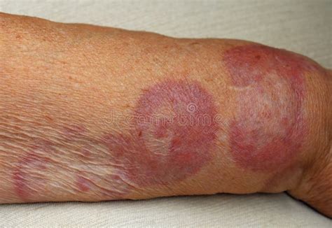 Granuloma Annulare, a Rare Skin Disease. Stock Image - Image of ...