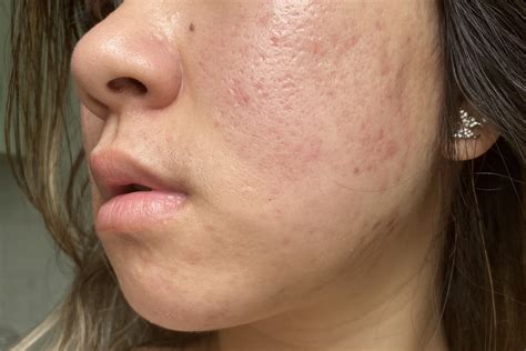 what can i do about these scars? please help! – Acne Scars – Acne.org Forum
