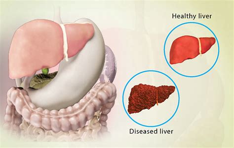 Health Condition : Symptoms, Causes, Treatment and More