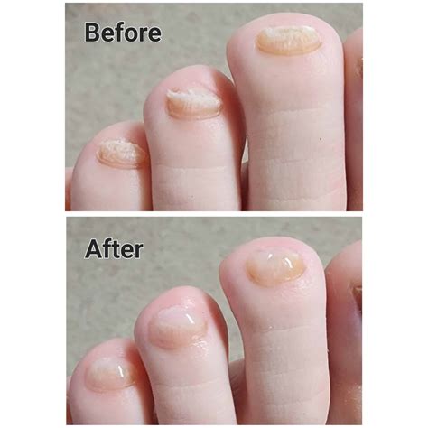 KeryFlex Nail Restoration | The Footcare Clinic