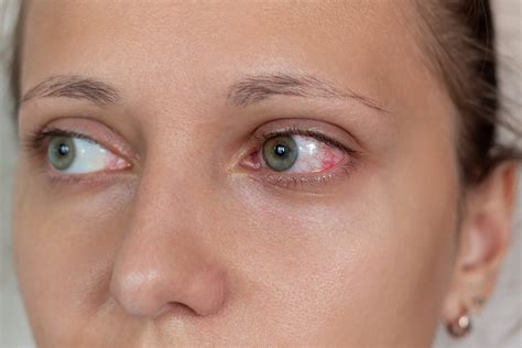 Eye Infection: Top Symptoms and Effective Treatment Options