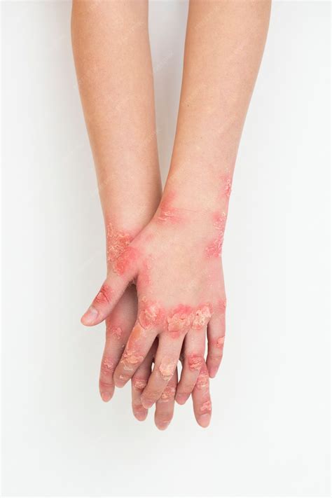 Psoriasis Hands And Feet Pictures