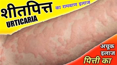 shit pitta urticaria   home remedies bra bra patata nakalna