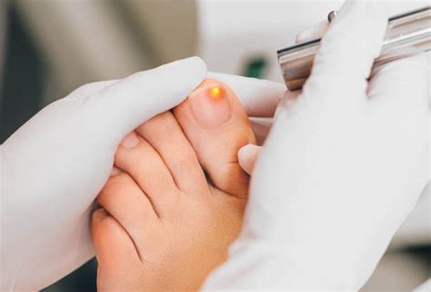 Uñas Enfermas - Banco de fotos e imágenes de stock - iStock