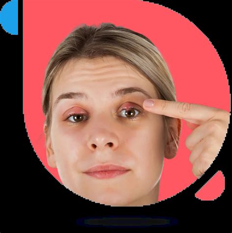 Stye Treatment and Prevention | The CareMD