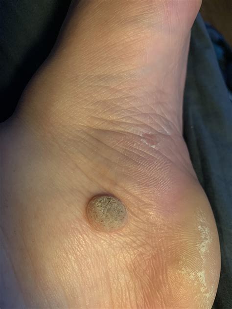 Wart resisting SA patches and cantharidin - any suggestion before a