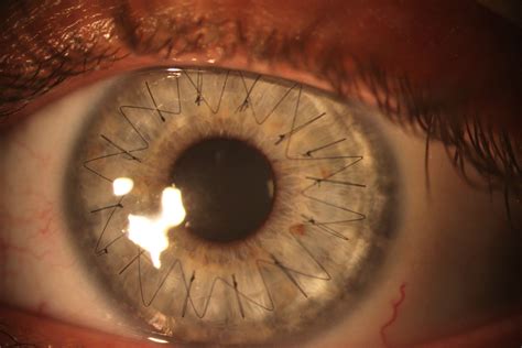 What is Cornea Transplant? | Hill Regional Hospital