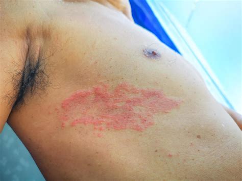 Painful back skin rash with blisters in a limited area.A man who had