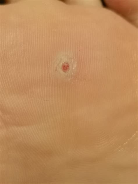 Plantar Wart Bleeding at Michael Birdwood blog