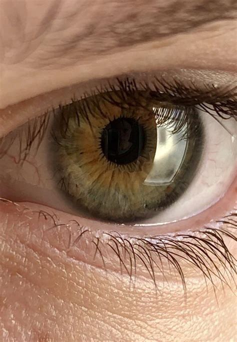 Central Heterochromia
