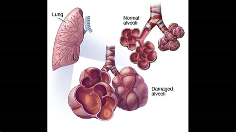 Come trattare enfisema - YouTube