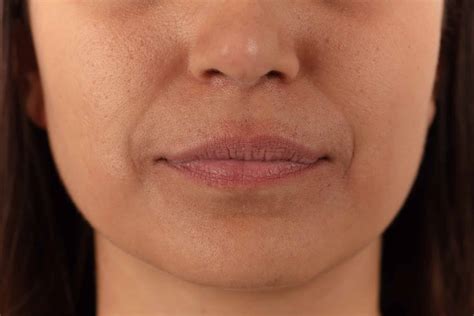 6 Common Lip Conditions and How Lip Fillers Can Treat Them - SL