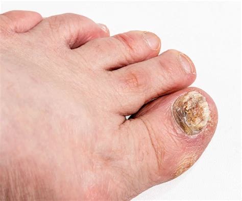 Mycose Ongle Pied Traitement Efficace Javel: Votre Solution Miracle à ...