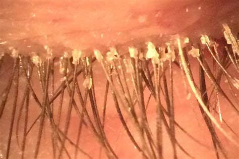 Anterior Blepharitis