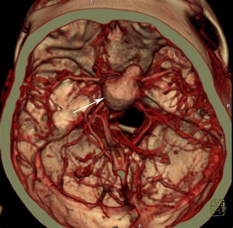 Internal Carotid Artery Aneurysm Visualized During Su - vrogue.co