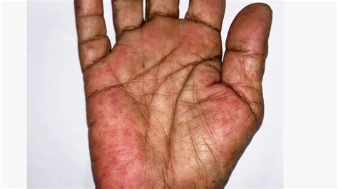 Rheumatoid arthritis rash – Artofit