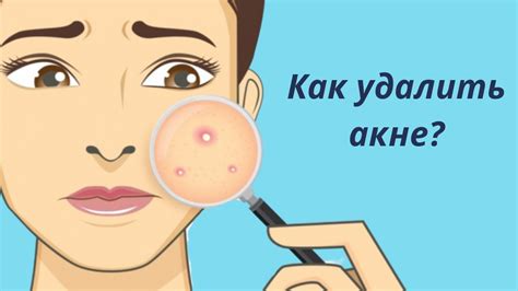 Акне - YouTube