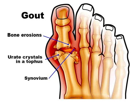 Gout: 10 Symptoms of Gout