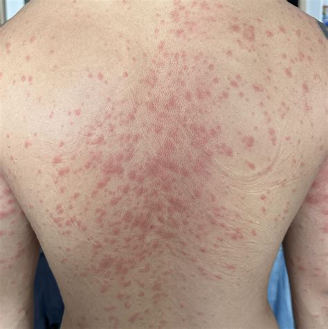 Christmas tree rash? : r/PityriasisRosea