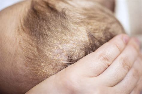 Seborrheic Dermatitis | VitalSkin Dermatology