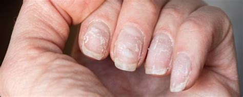 Prevenir y tratar las estrías en las uñas | Blog Druni