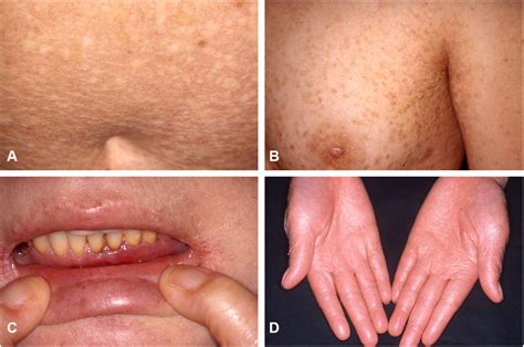 Oral Epidermolysis Bullosa Epidermolysis Bullosa Dermatology Sydney