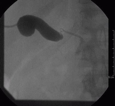 biliary anesthesia key
