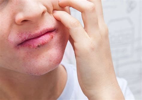 4 Ways to Improve Lip Dermatitis – A Dermatologist's 5-Minute Guide