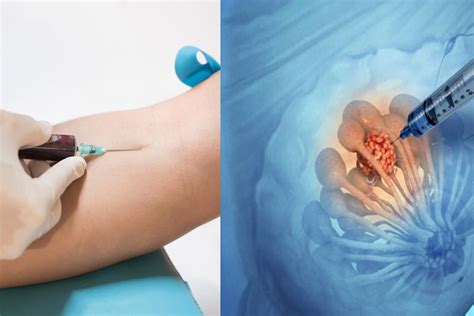 Liquid Biopsy versus Traditional Tissue Biopsy - Integrative Cancer Care