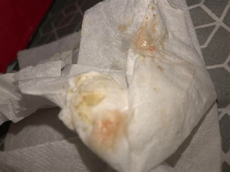 Aftermath of a cyst pop. : r/popping