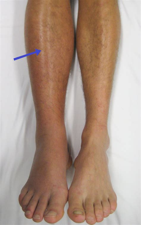 DVT Calve Pain vs. Pulled Calve Muscle Soreness » Scary Symptoms