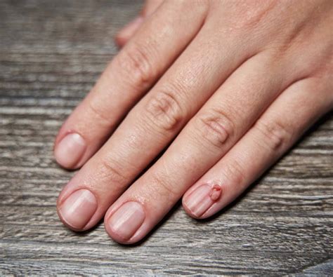 periungual warts recognition treatment