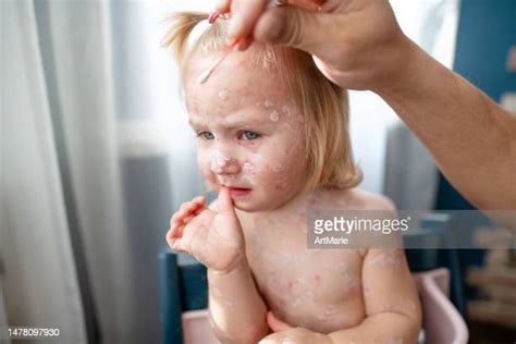 127 Chickenpox Rash Stock Photos, High-Res Pictures, and Images - Getty ...