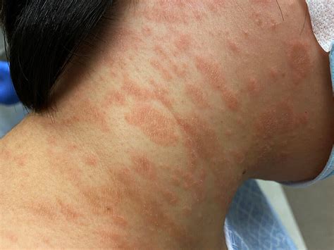 pityriasis rosea rash bild kaufen  science photo library