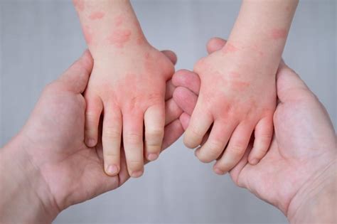 Hand, Foot & Mouth Disease (HFMD) Treatment in Beverly Hills