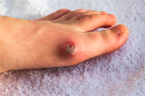Pie Diabético – Nanoskin